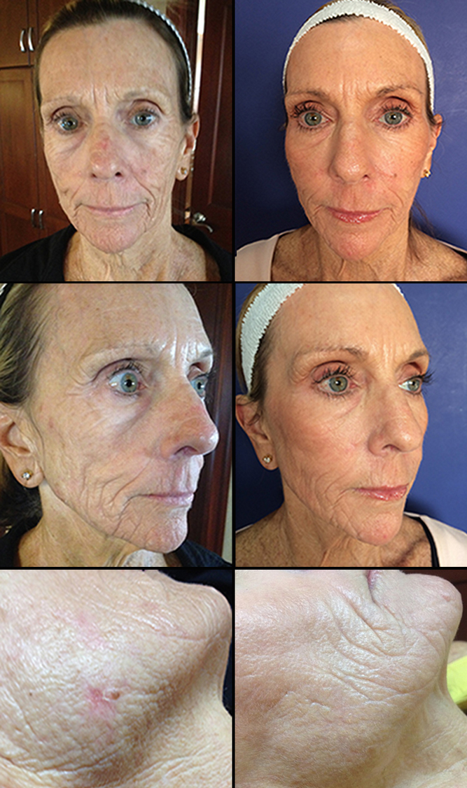 CO2 Laser Skin Resurfacing  Dr Monica Scheel Dermatology, Kailua-Kona, HI